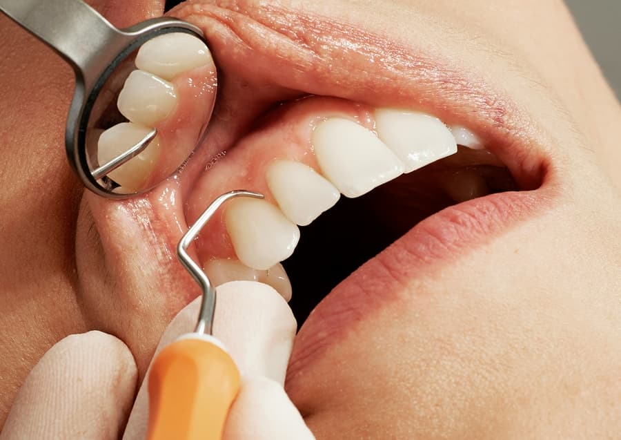 An oral examination using a dental mirror and instruments