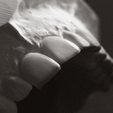 ZERONATE vs Veneers: What's the Difference?