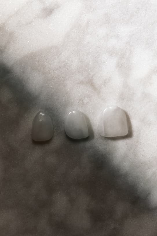 What Are No-prep Veneers? The Difference from Traditional Veneers