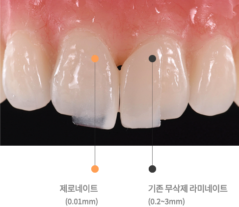 기존 무삭제 라미네이트(0.2~3mm), 제로네이트(0.01mm)